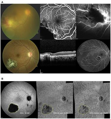 Comparison of Indocyanine Green Angiography and Swept-Source Wide-Field Optical Coherence Tomography Angiography in Posterior Uveitis